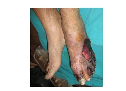 Can thiệp nội mạch điều trị tắc động mạch vùng dưới gối