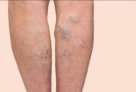 Điều trị huyết khối tĩnh mạch sâu chi dưới giai đoạn cấp