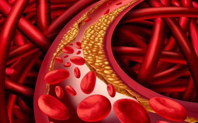 Điều trị tăng cholesterol máu ở người cao tuổi