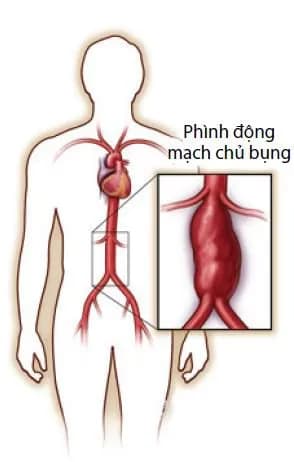 Các siêu âm bụng, chụp chiếu giúp đánh giá phình động mạch chủ bụng