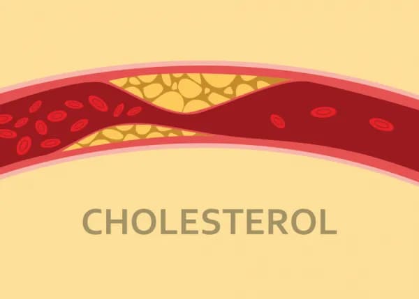 Cholesterol cao dẫn đến xơ vữa động mạch như thế nào?