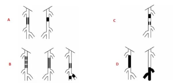 Can thiệp động mạch đùi nông: Những điều cần biết