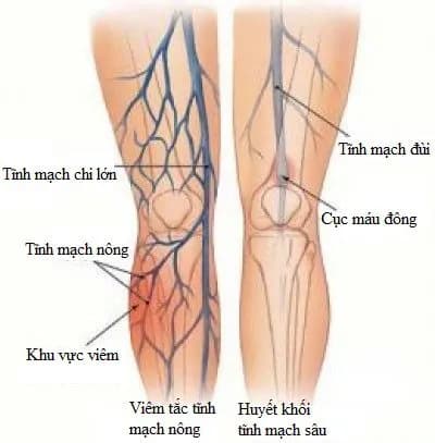 Can thiệp nội mạch điều trị thiếu máu chi trầm trọng