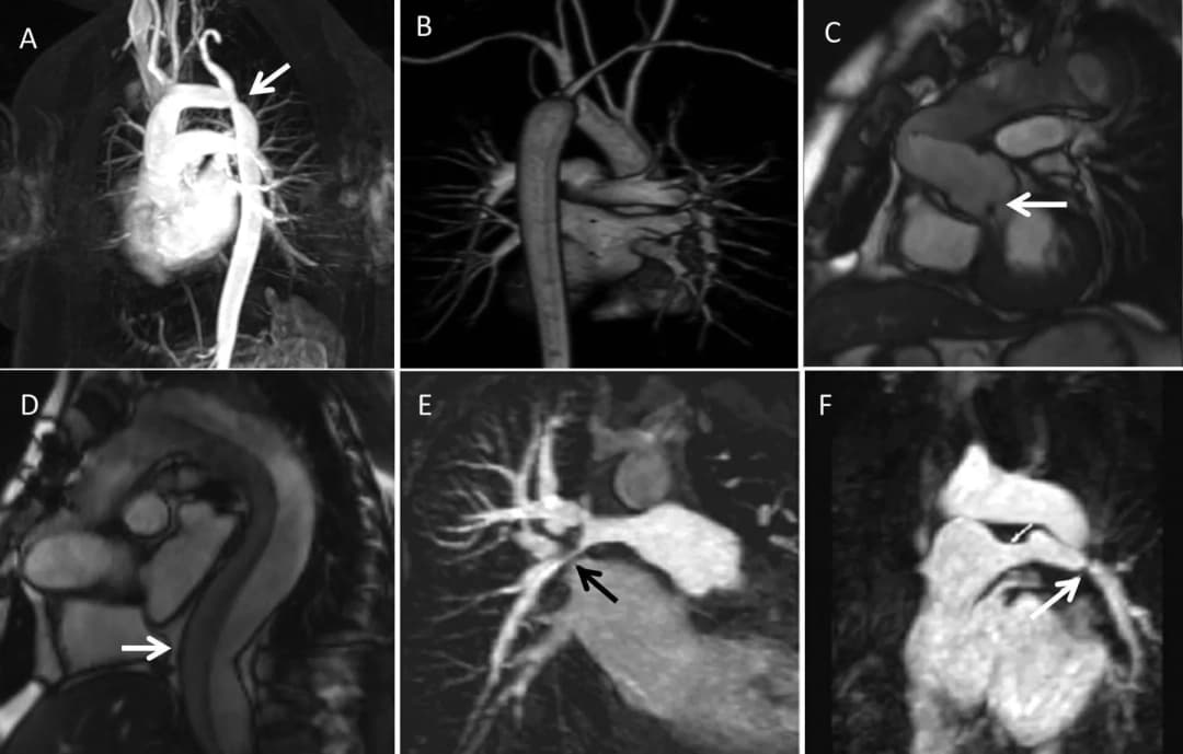 Ứng dụng của cộng hưởng từ tim mạch trong chẩn đoán suy tim