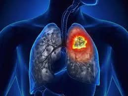 Đau thắt ngực trong hoặc sau khi chơi thể thao có đáng ngại?