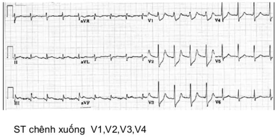 Các dấu ấn tim trong chẩn đoán sớm hội chứng mạch vành cấp