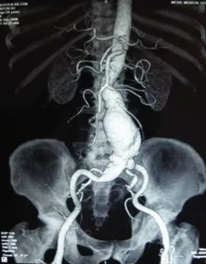 Các trường hợp chống chỉ định can thiệp mạch vành