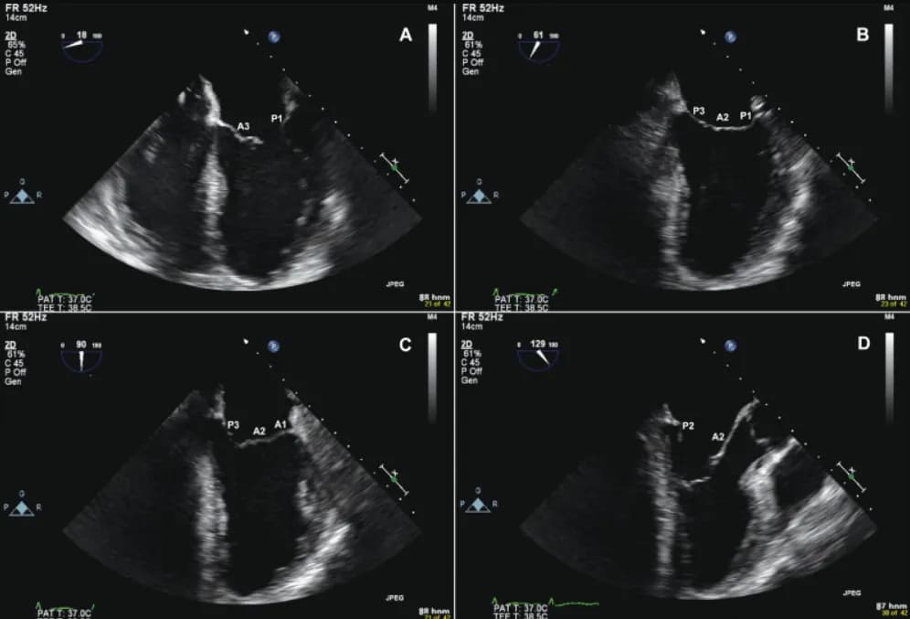 Siêu âm tim mạch qua thành ngực (TTE)