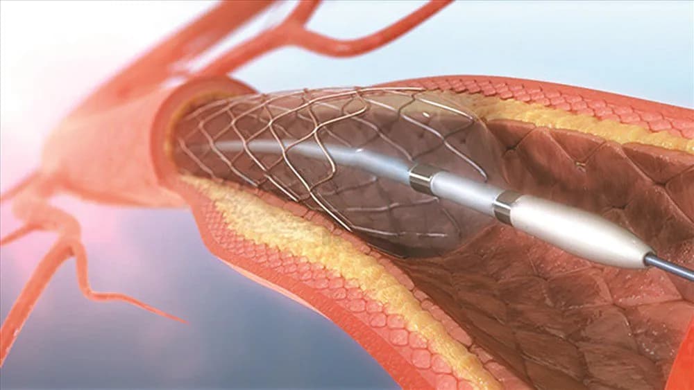 Tuổi thọ có stent động mạch vành