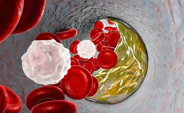 Xơ vữa động mạch chi dưới: Dấu hiệu và điều trị