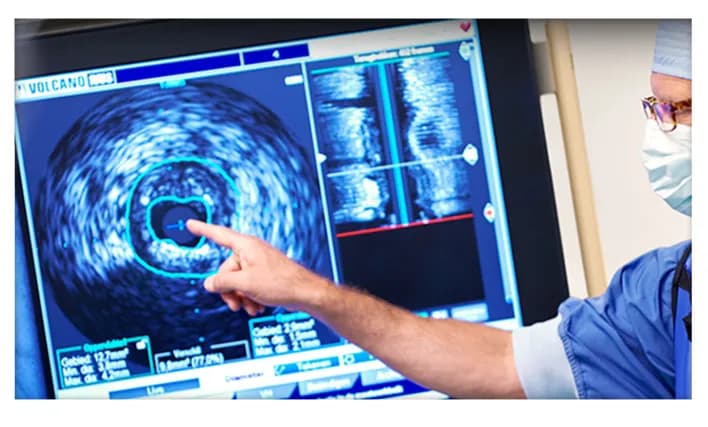 Ý nghĩa và ứng dụng của siêu âm trong lòng mạch vành (IVUS)