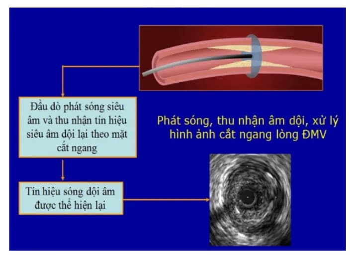 Ý nghĩa và ứng dụng của siêu âm trong lòng mạch vành (IVUS)
