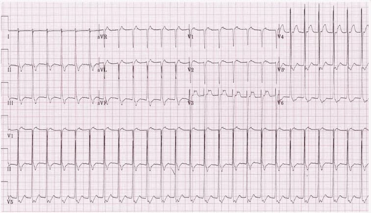 Cập nhật tiêu chuẩn chẩn đoán nhồi máu cơ tim