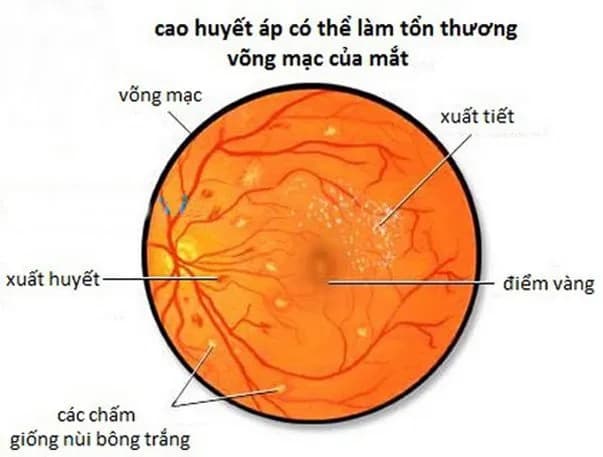 Dấu hiệu võng mạc trong tăng huyết áp