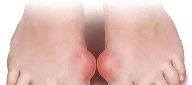 Viêm khớp điển hình do gout cấp