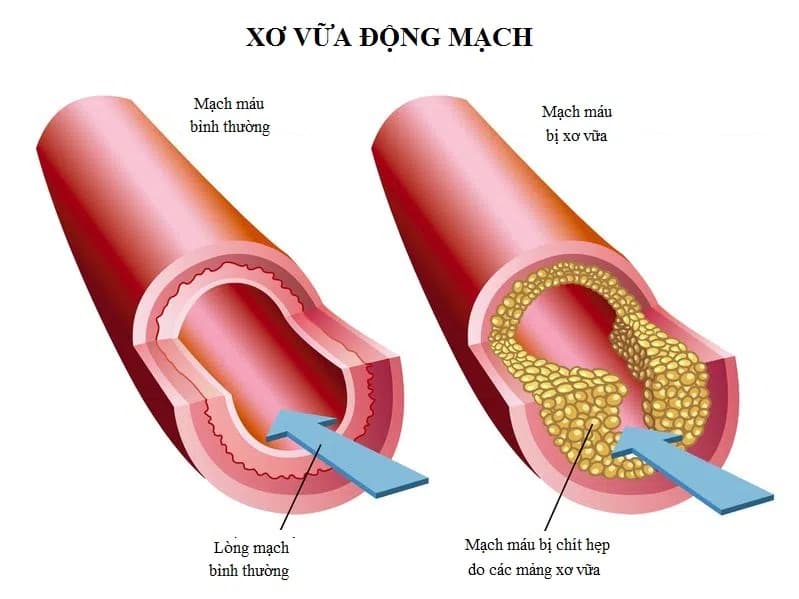 Xơ vữa động mạch là gì? 