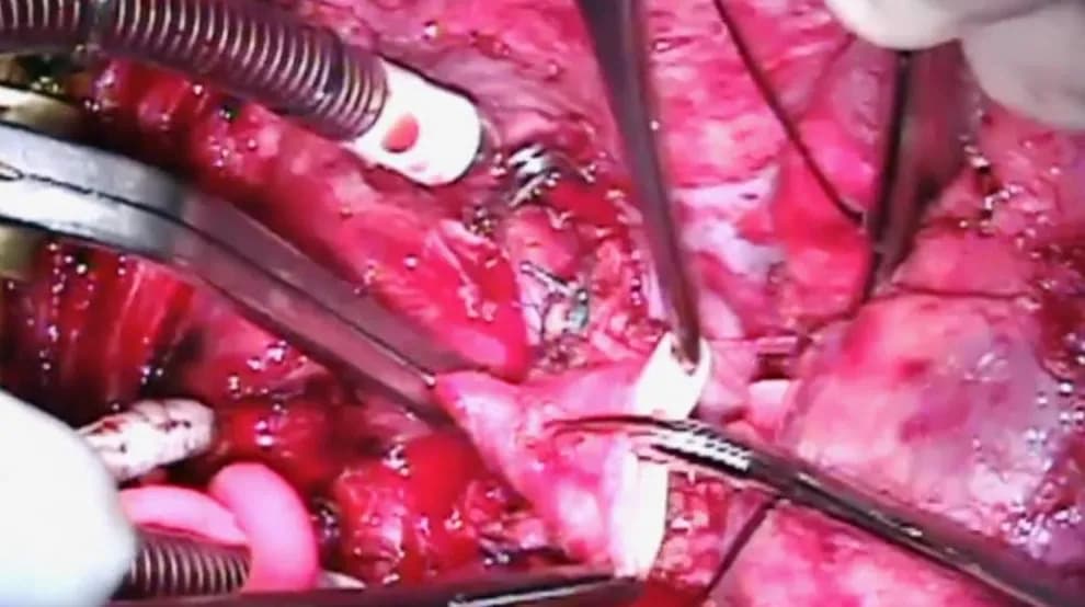 Tim một thất là bệnh gì?