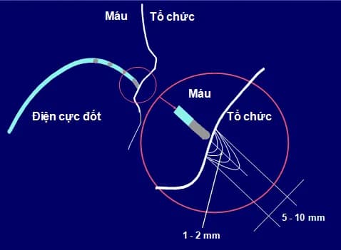 Điều trị rối loạn nhịp tim nhanh ở trẻ em