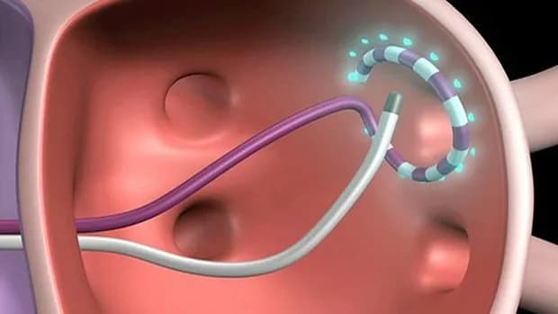 Điều trị rung nhĩ như thế nào?