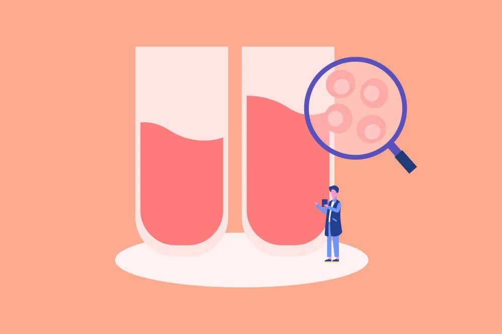 Huyết khối động mạch thận ở người bệnh rung nhĩ