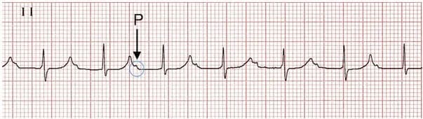 Block nhĩ thất độ 2: Những điều cần biết