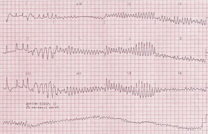 Nhịp tim nhanh có nguy hiểm không?
