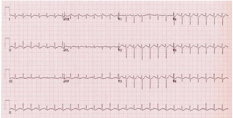 Nhịp xoang nhanh có nguy hiểm không?