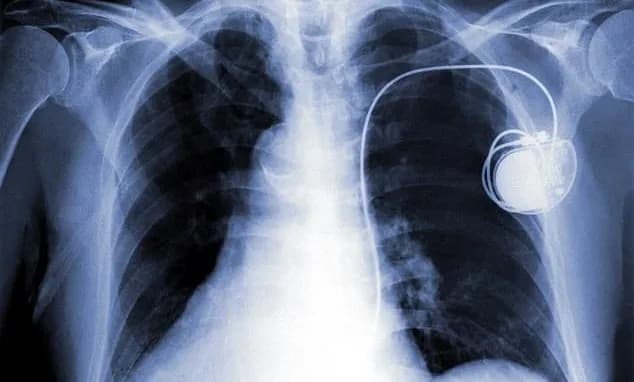 Tổng quan về máy tạo nhịp tim