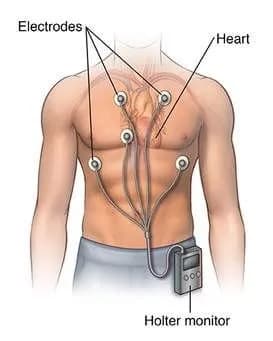 Holter điện tâm đồ là gì và có ý nghĩa thế nào trong chẩn đoán rối loạn nhịp tim?