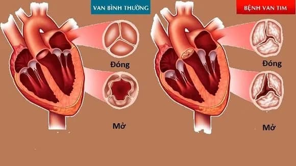 Bệnh van tim: Khi nào cần phẫu thuật?