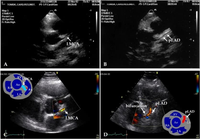 Vai trò siêu âm tim trong chẩn đoán bệnh van động mạch chủ