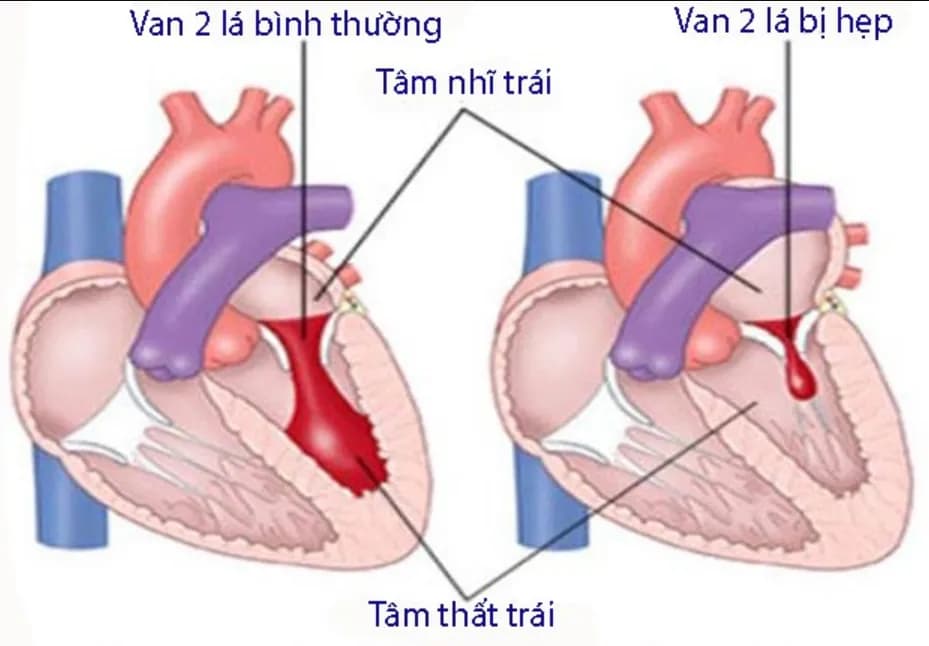 Bệnh van tim ở phụ nữ mang thai