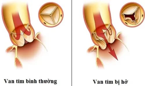 Hở van tim 3 lá 1/4 có nguy hiểm không ?