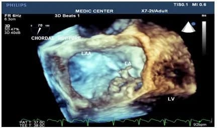 Siêu âm tim 3D trong đánh giá và can thiệp các bệnh van tim