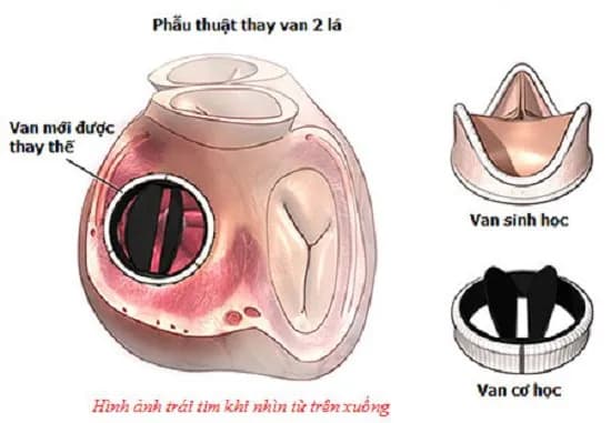 Hẹp van 2 lá: Các biện pháp điều trị
