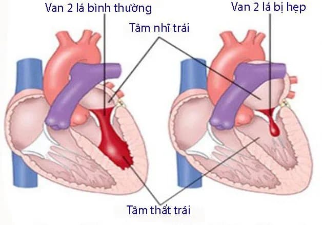 Hẹp van 2 lá: Các biện pháp điều trị