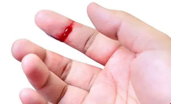 Kết dính tiểu cầu và nguy cơ huyết khối