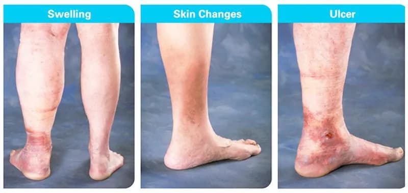 Chẩn đoán huyết khối tĩnh mạch sâu chi dưới