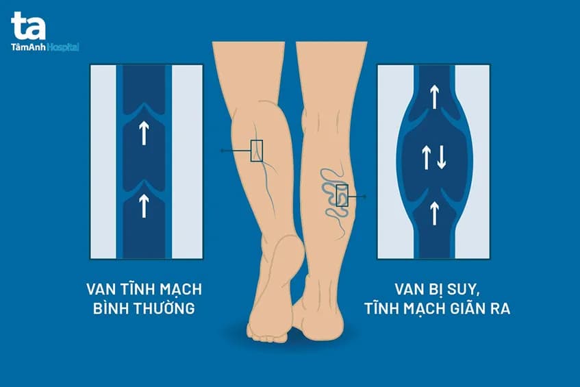 Suy giãn tĩnh mạch chi dưới: Nguyên nhân, dấu hiệu, cách điều trị