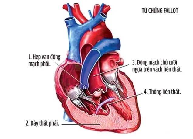 Siêu âm tim trong tứ chứng Fallot