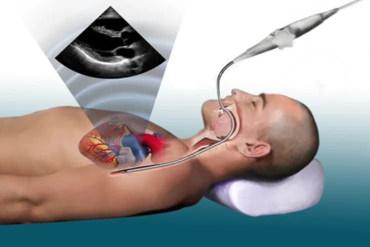 Chỉ định của siêu âm tim qua thực quản