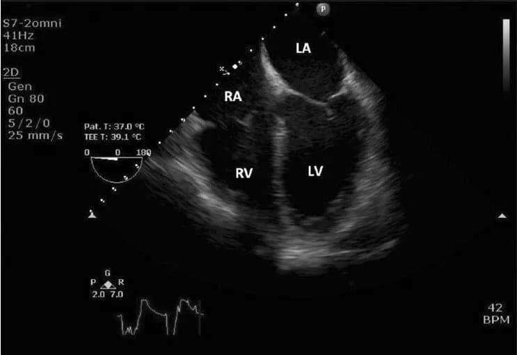 Quy trình siêu âm tim chuẩn hiện nay