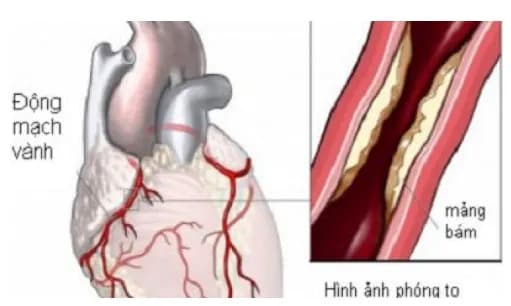 Tắc động mạch thận cấp