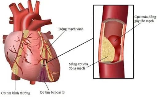 Có thể giảm sự tích tụ mảng bám mạch máu không?