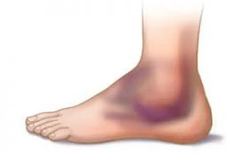 Viêm tĩnh mạch huyết khối là gì?