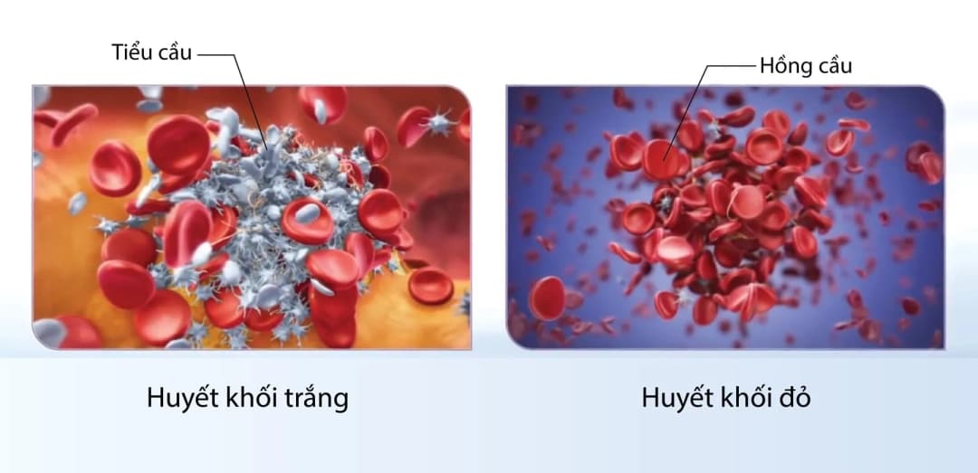 Huyết khối là gì và cơ chế hình thành