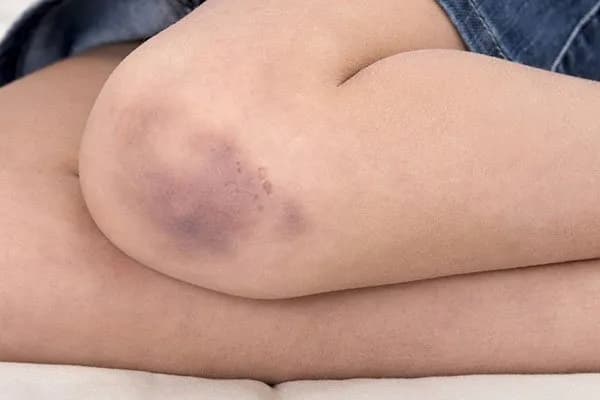 Thế nào là đông máu rải rác trong lòng mạch?