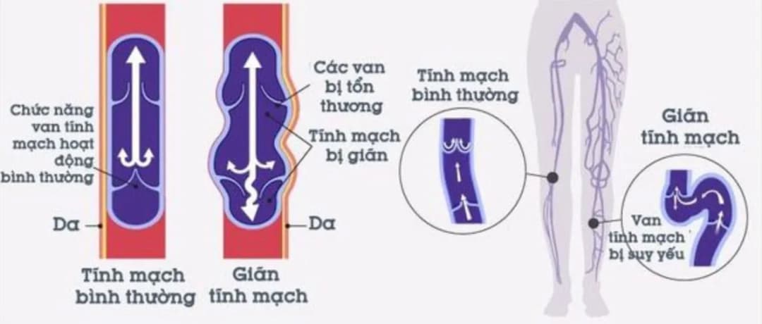 Chẩn đoán và điều trị suy giãn tĩnh mạch chi dưới mãn tính