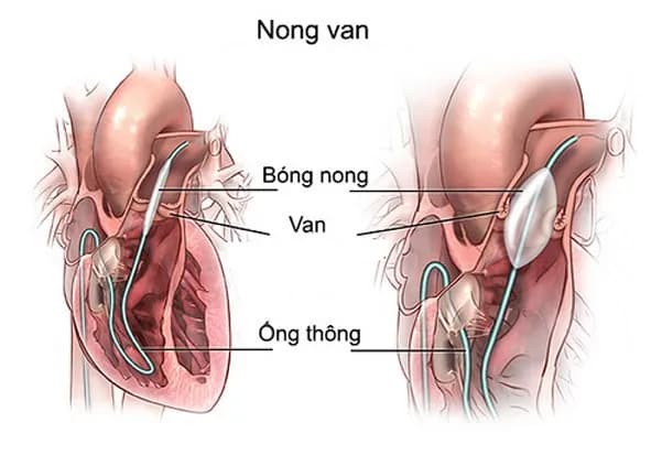 Lưu ý trong nong van tim bị hẹp bằng bóng