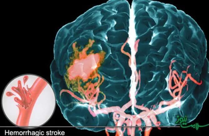 Nguyên nhân gây bệnh mạch máu dạng bột